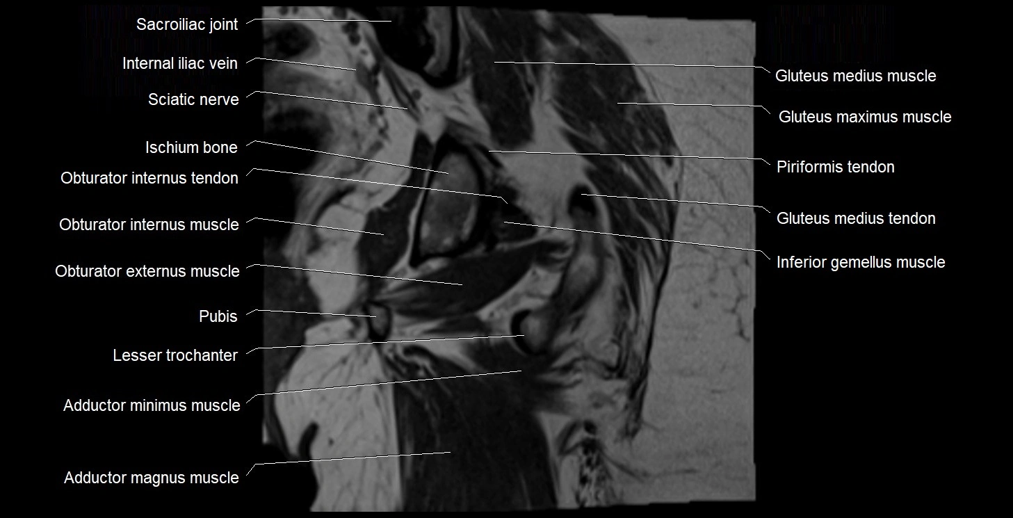 MRI Hip 3T coronal cross sectional anatomy image 43.webp